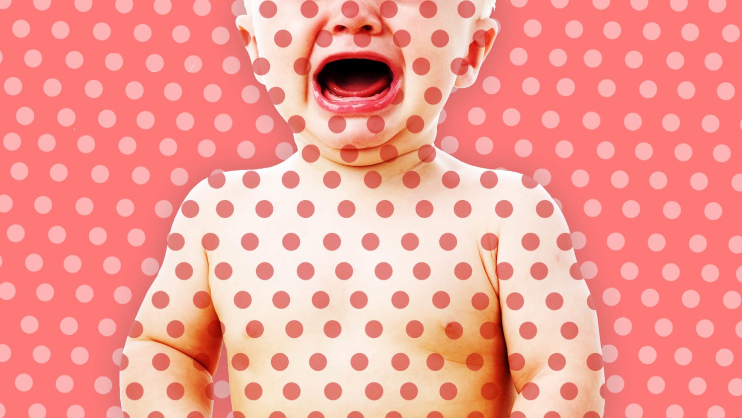 Measles: Rare, but Still There